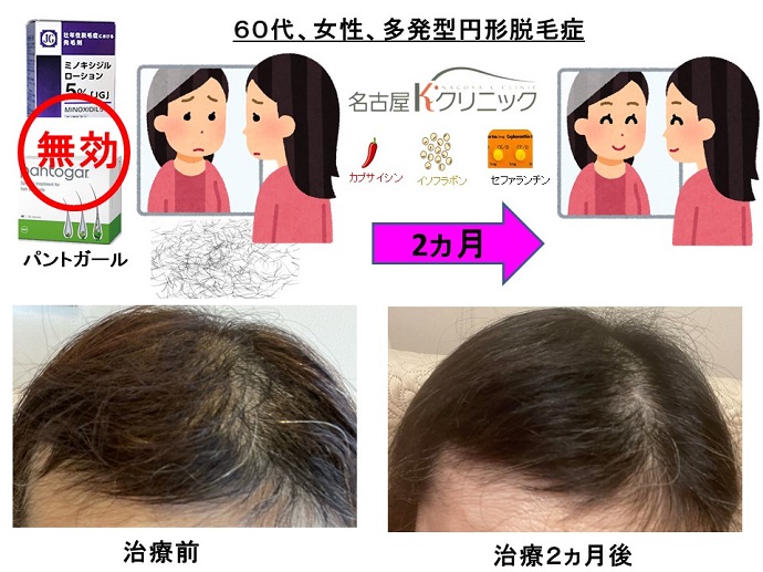 円形脱毛症　病院